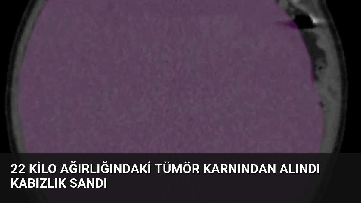 22 Kilo Ağırlığındaki Tümör Karnından Alındı Kabızlık Sandı