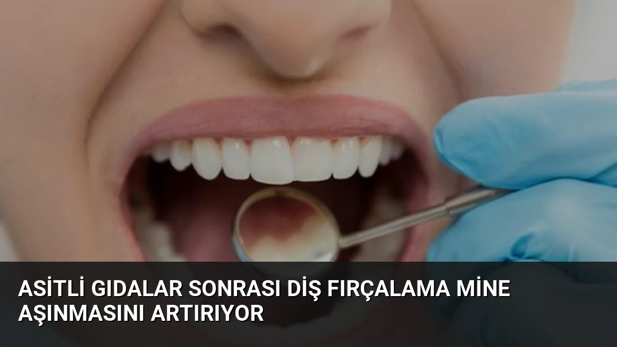 Asitli Gıdalar Sonrası Diş Fırçalama Mine Aşınmasını Artırıyor
