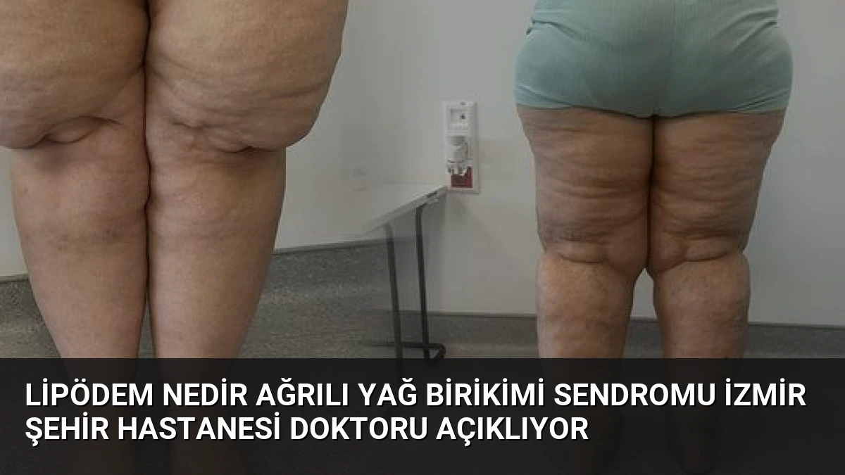 Lipödem Nedir Ağrılı Yağ Birikimi Sendromu İzmir Şehir Hastanesi Doktoru Açıklıyor