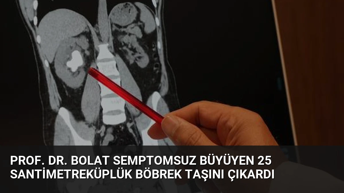 Prof. Dr. Bolat Semptomsuz Büyüyen 25 Santimetreküplük Böbrek Taşını Çıkardı